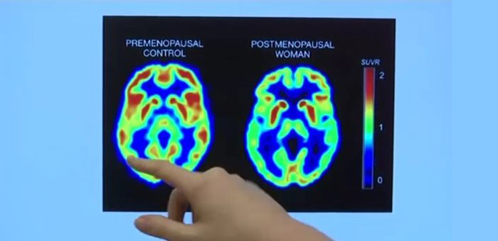 menopausa e alzheimer nelle donne